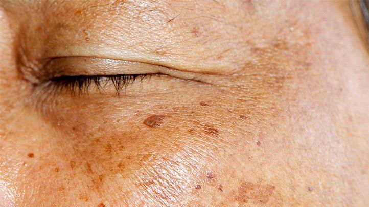 Las manchas de la edad: 10 remedios para hacer en casa