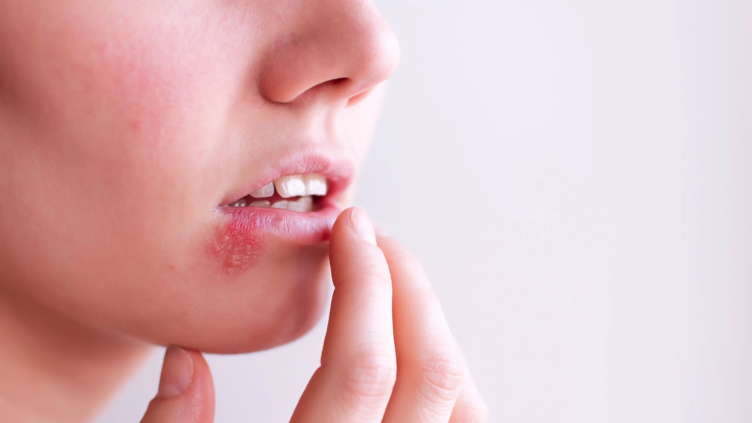 el herpes genital:10 tratamientos naturales