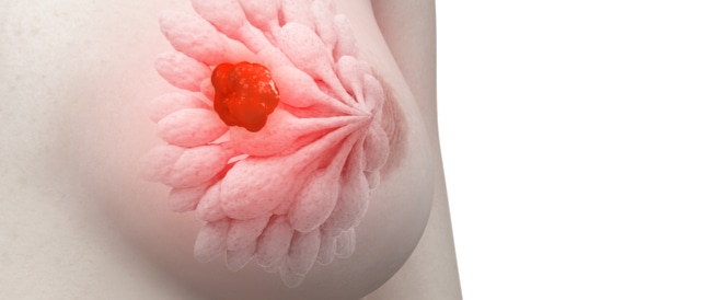 ¿Cómo prevenir el cáncer de mama?